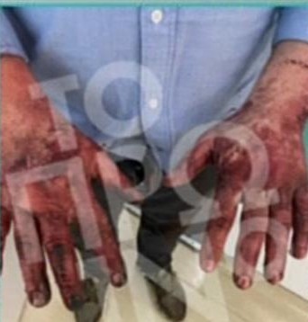 Σοκαριστικές εικόνες από τα χέρια του ανθρώπου που έβγαλε τη σύζυγο του Μονογυιού από τη φλεγόμενη Ferrari (vid)