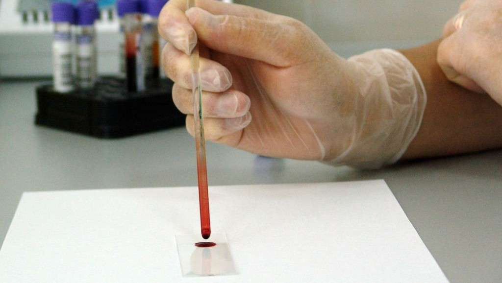 Στα 39 τα κρούσματα της ευλογιάς των πιθήκων στην Ελλάδα – Όλοι άνδρες