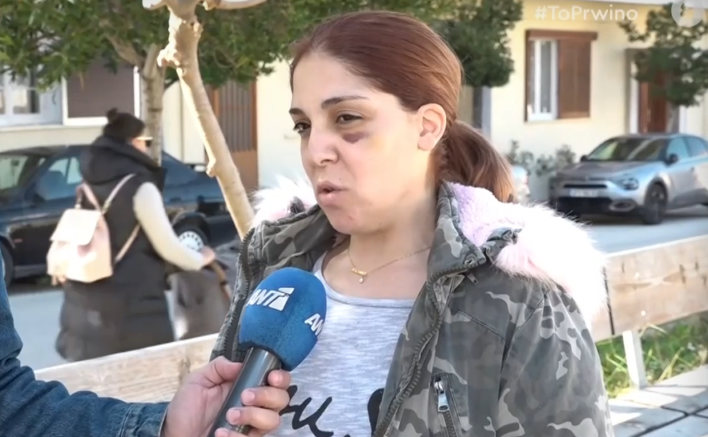 «Με απείλησε ότι θα κάψει τα παιδιά μας»: Συγκλονίζει η 32χρονη στο Άργος -Δείχνει το χτυπημένο πρόσωπό της
