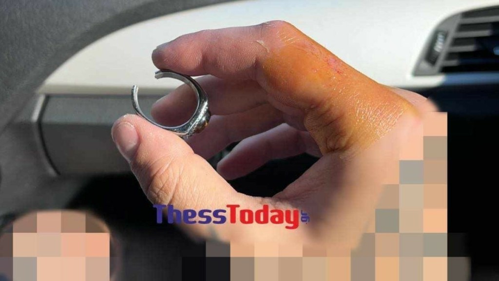 Χαλκιδική: Προσπάθησαν να αφαιρέσουν δαχτυλίδι από πρησμένο δάχτυλο με σύμβουλο…το youtube