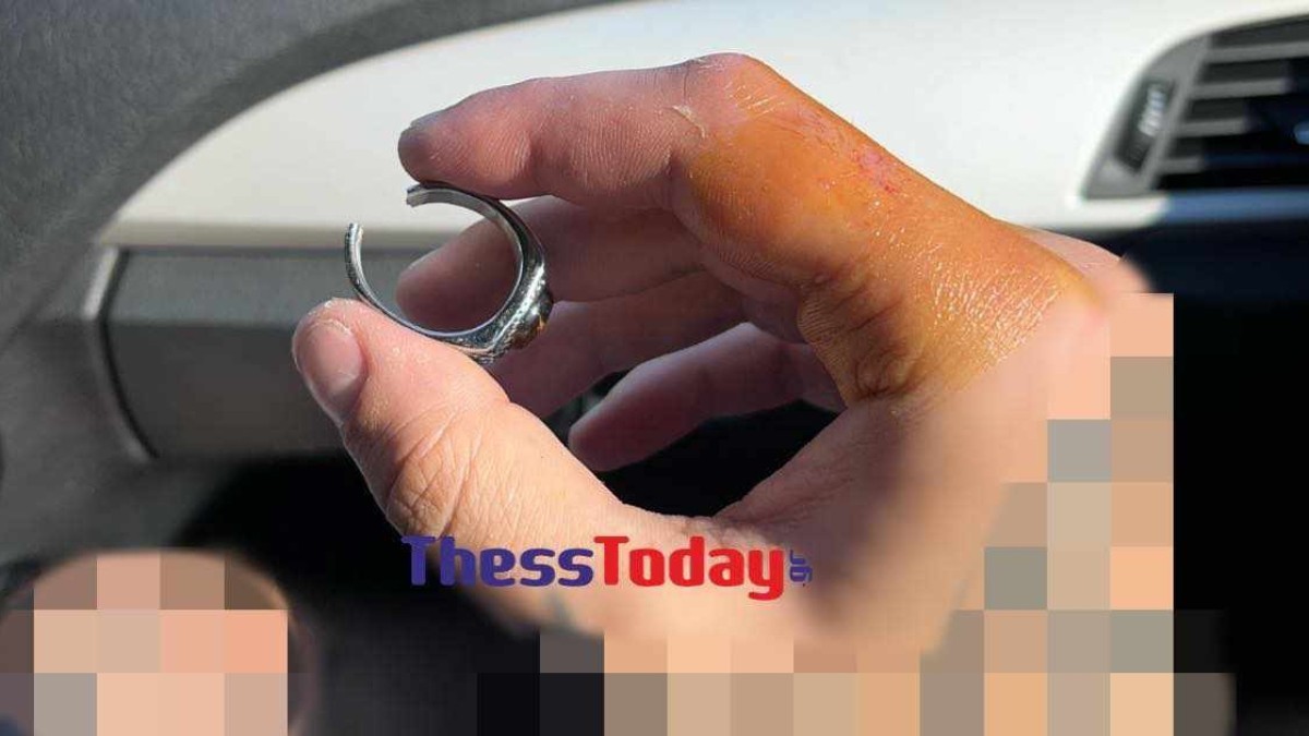 Χαλκιδική: Προσπάθησαν να αφαιρέσουν δαχτυλίδι από πρησμένο δάχτυλο με σύμβουλο…το youtube