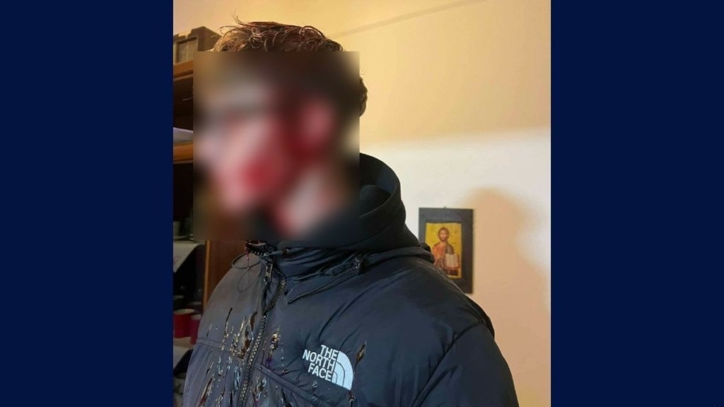 Θεσσαλονίκη: Φωτογραφία-σοκ από τον 16χρονο μετά την επίθεση – Μέσα στα αίματα το πρόσωπό του