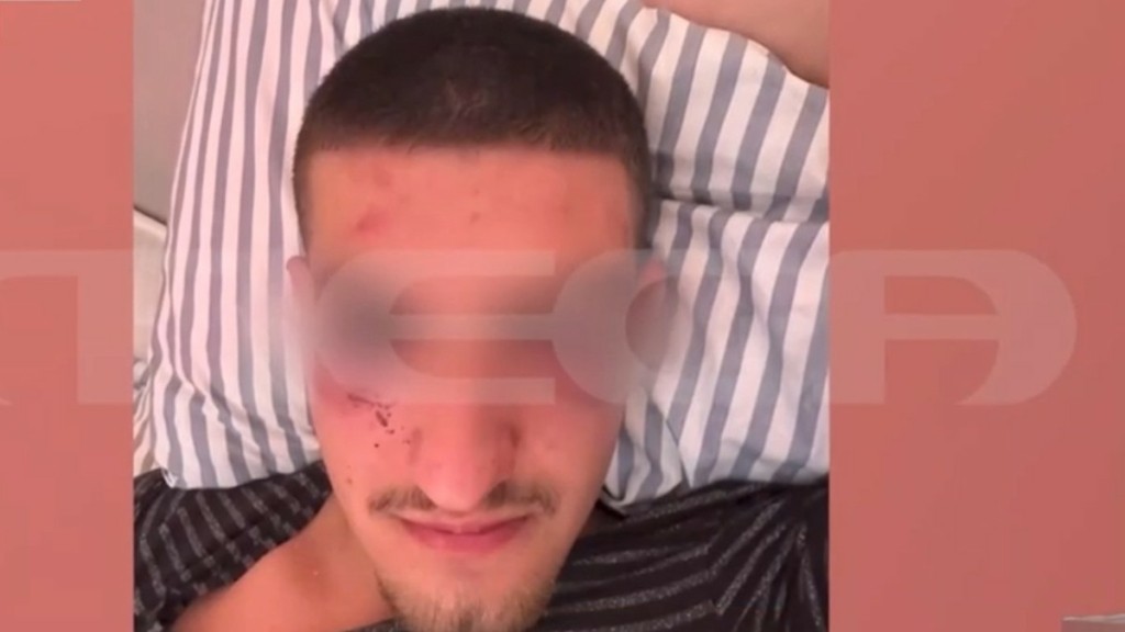 Κέρκυρα: «Με χτύπησαν γιατί ευχήθηκα καλή χρονιά σε μία κοπέλα» – Συγκλονίζει το 17χρονο θύμα του άγριου ξυλοδαρμού