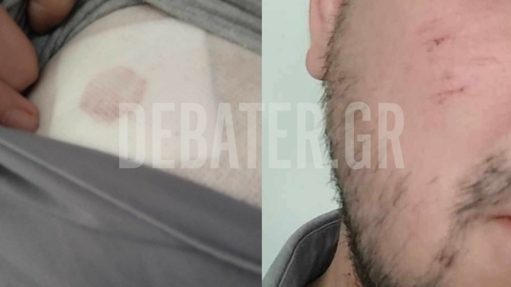 Αποκλειστικό DEBATER: Ληστές στο Αιγάλεω κάρφωσαν πολίτη με σπασμένο μπουκάλι (Φωτογραφίες)