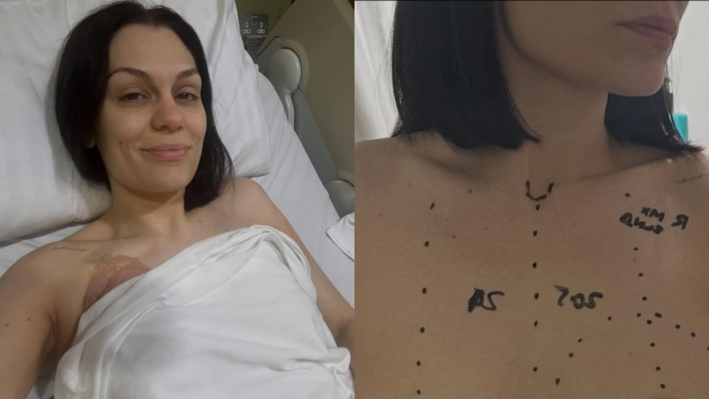 Jessie J: Υποβλήθηκε σε χειρουργική επέμβαση για τον καρκίνο του μαστού – Το μήνυμά της