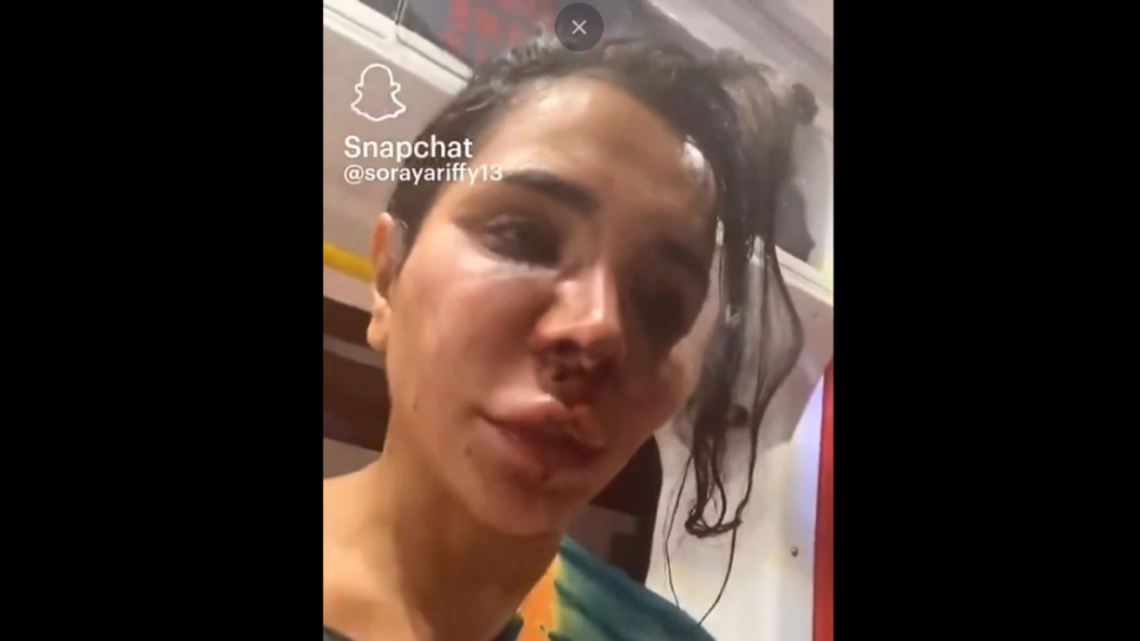 Εφιάλτης για 30χρονη influencer στη Γαλλία: Διαρρήκτες την χτύπησαν, την έδεσαν και την ψέκασαν με χλωρίνη (βίντεο)