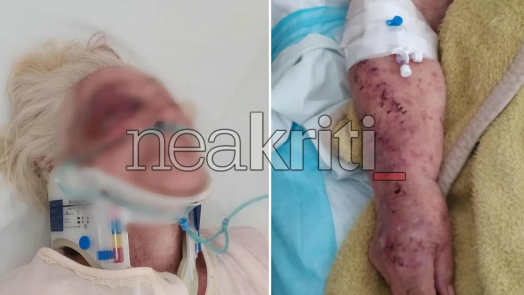 Ηράκλειο: Ηλικιωμένη παρασύρθηκε από ανήλικο οδηγό μηχανής – Σοκάρουν οι εικόνες  (Εικόνα)