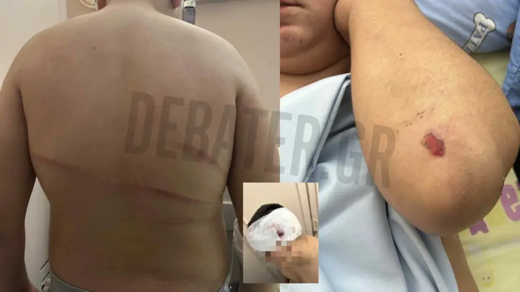 Θεσσαλονίκη: Σοκ από την επίθεση σε 13χρονο – Δίωξη για απόπειρα ανθρωποκτονίας σε 18χρονο