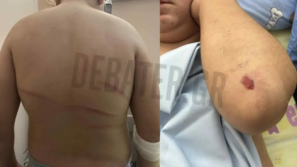 Θεσσαλονίκη: Διαφωνία ανακρίτριας και εισαγγελέα για τον 18χρονο που ξυλοκόπησε 13χρονο στις Συκιές – Σε κατ΄οίκον περιορισμό ο δράστης 