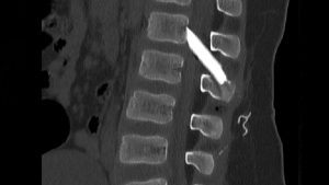 Metropolitan Hospital: Επιτυχής χειρουργική επέμβαση στη σπονδυλική στήλη παιδιού με σοβαρά τραύματα από γυαλί