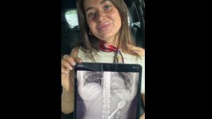 Βέλγιο: 28χρονη κατάπιε κουτάλι 17 εκατοστών όταν πήδηξε πάνω της ο σκύλος της (Βίντεο)