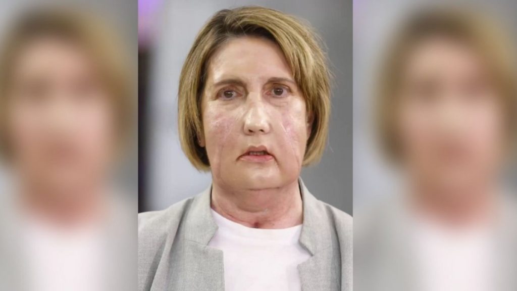 Ισπανία: Η πρώτη μεταμόσχευση προσώπου με δότη γυναίκα που υποβλήθηκε σε υποβοηθούμενη ευθανασία