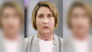 Ισπανία: Η πρώτη μεταμόσχευση προσώπου με δότη γυναίκα που υποβλήθηκε σε υποβοηθούμενη ευθανασία