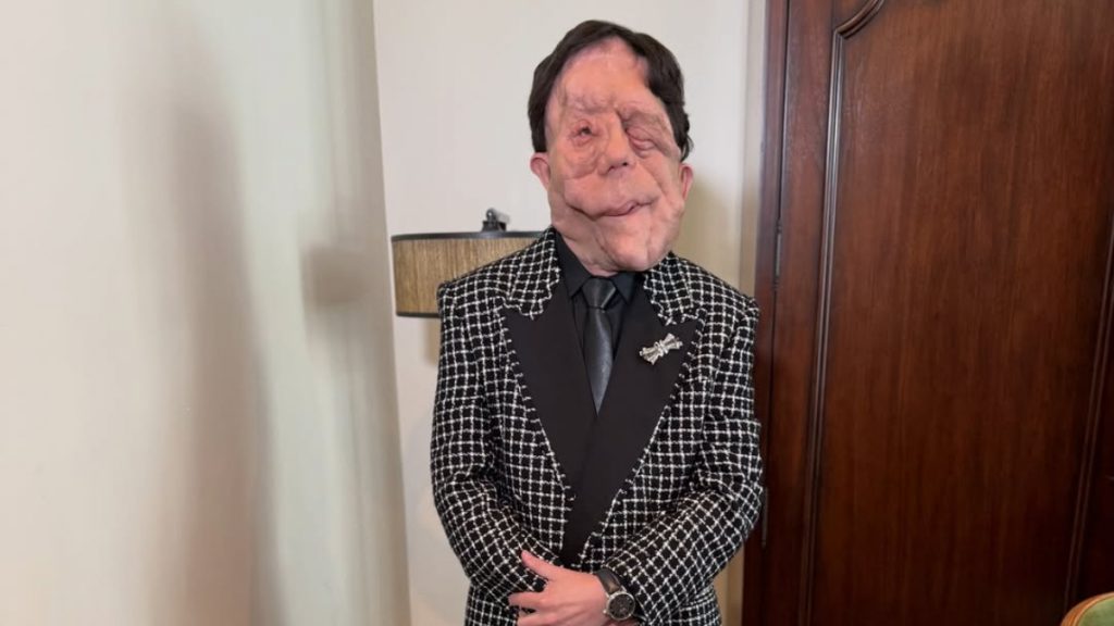 Adam Pearson: Τι είναι η νευροϊνωμάτωση από την οποία πάσχει – Η διάγνωση & οι θεραπευτικές επιλογές