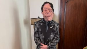 Adam Pearson: Τι είναι η νευροϊνωμάτωση από την οποία πάσχει – Η διάγνωση & οι θεραπευτικές επιλογές