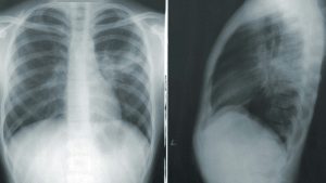 Καρκίνος του πνεύμονα: Μπορεί να εμφανιστεί και σε ανθρώπους που δεν κάπνισαν ποτέ στη ζωή τους 