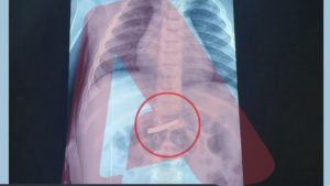 Αγοράκι 3 ετών κατάπιε ξυραφάκι – Νοσηλεύεται στο Παίδων